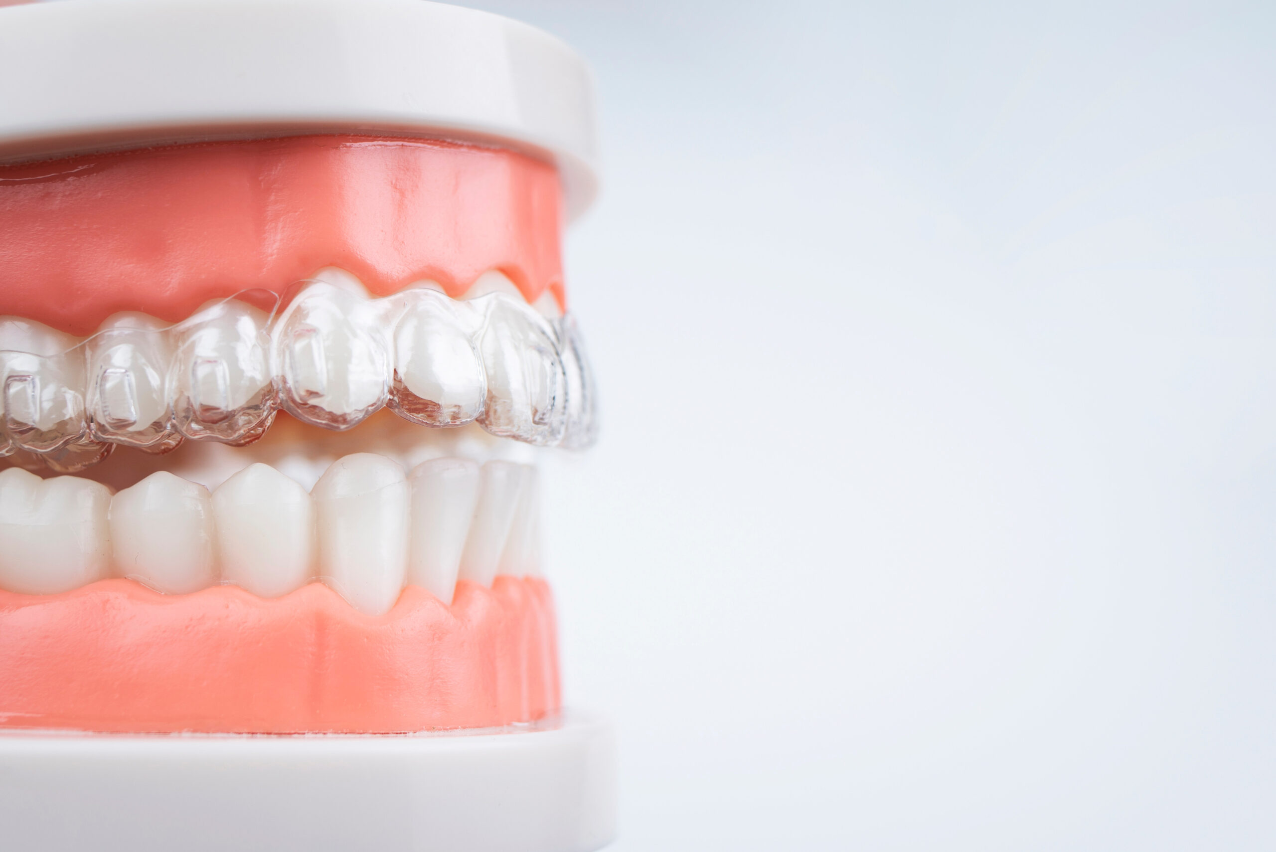 Custom Mouth Guards in Wyoming - Craft Dentistry